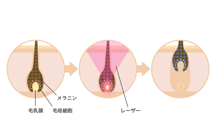 脱毛の仕組み