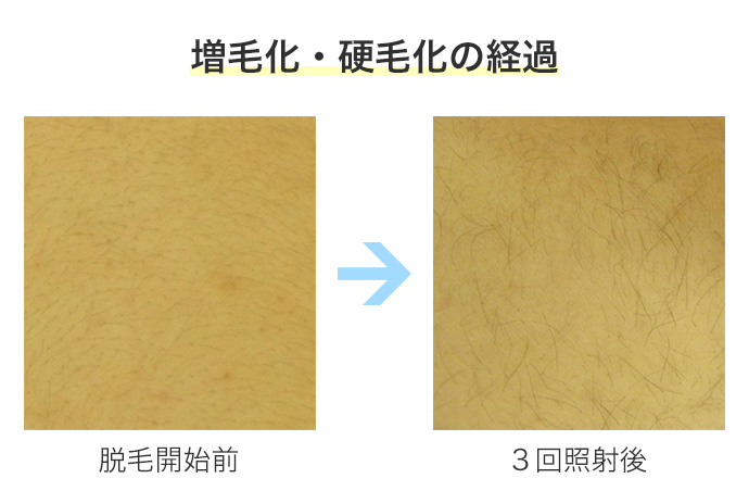 増毛化・硬毛化症例